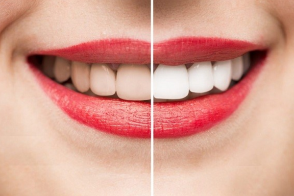 Tẩy trắng có làm ảnh hưởng men răng?