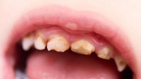 Vì sao răng sữa bị sâu?
