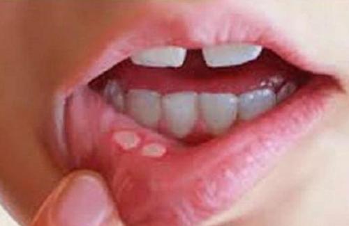 Bệnh nấm miệng có lây không?