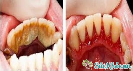 Hiệu quả sau khi sử dụng Nha chu tán làm sạch mảng bám cao răng
