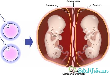 Đa thai cũng có thể dẫn tới sinh non do vậy các mẹ cần chú ý xem có dấu hiệu sinh non không