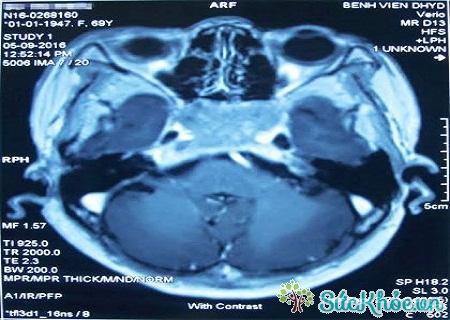Hình ảnh của u sàn sọ não sau khi chụp CT scan não