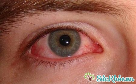 Bệnh đau mắt đỏ chủ yếu do virus adeno gây ra 