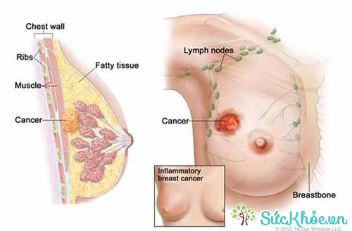 Tế bào ung thư vú đang phát triển
