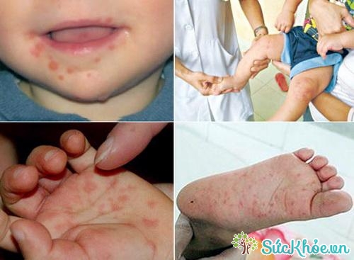 Bệnh chân tay miệng là bệnh truyền nhiễm rất thường gặp ở trẻ nhỏ