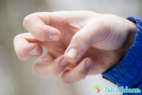 Động kinh cục bộ thường bắt đầu ở các ngón tay