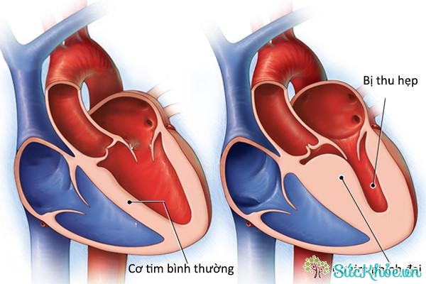 Phì đại cơ tim cũng gây rối loạn nhịp tim