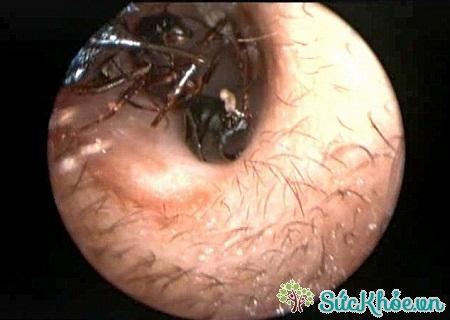 Côn trùng chui vào lỗ tai nên làm thế nào?