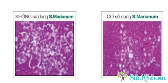 Sử dụng S. Marianum cải thiện đáng kể tình trạng viêm, xơ hóa gan