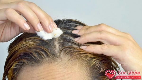 Da đầu không khỏe mạnh có thể gây ra tình trạng viêm trong các nang tóc, làm cho rụng thường xuyên