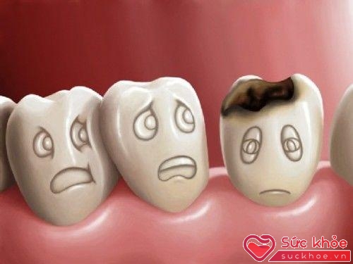 Bệnh răng miệng như viêm lợi, sâu răng, đeo hàm giả, nha chu...cũng gây ra kích thích nôn khan