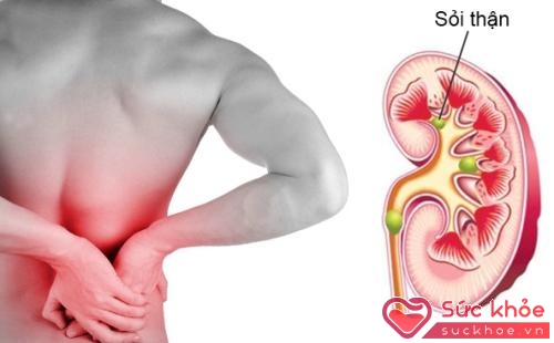 Sỏi thận có thể gây đau ở một bên hông, phần lưng.