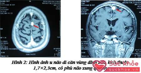 Hình ảnh u não di căn vùng đỉnh trái, kích thước 1,7 x 2,3cm, có phù não xung quanh.