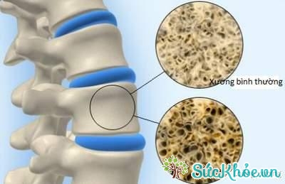 Loãng xương có thể có triệu chứng đau nhức xương khớp