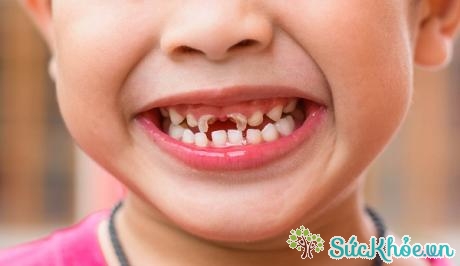 Trẻ bị sâu răng sữa có nguy cơ lưu giữ vi khuẩn 