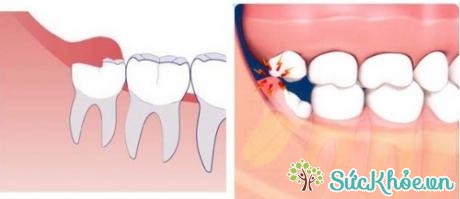 Cách điều trị răng khôn mọc lệch ở hàm dưới