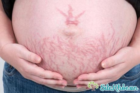 Bị rạn da khi mang thai phải làm sao?