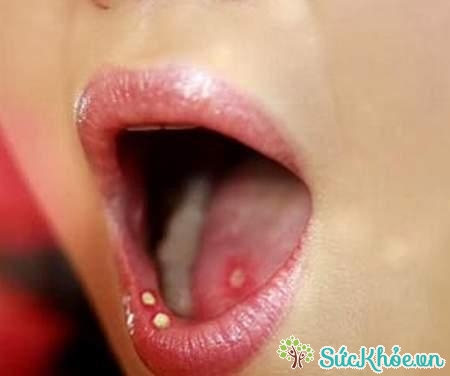 Viêm loét miệng lưỡi có thể là do nhiễm nấm