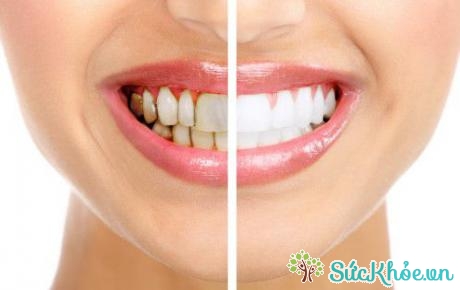 Vệ sinh răng miệng không sạch sẽ là một trong những nguyên nhân gây vàng răng